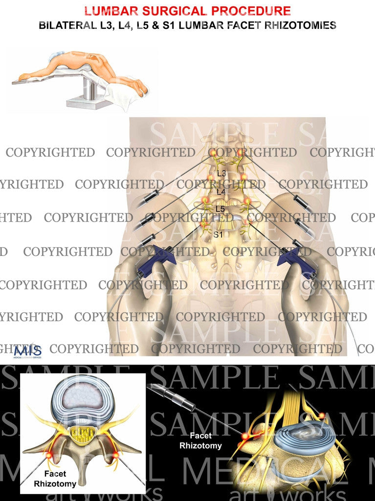 Lumbar Facet rhizotomies