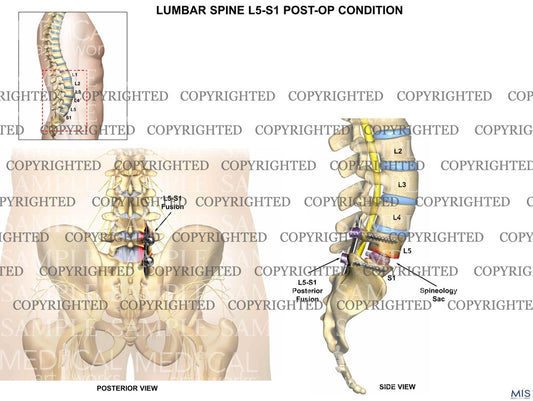 Post operative lumbar surgical procedure on L5-S1