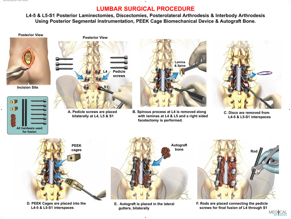 2 Level - L4-5 & L5-S1 Posterior lumbar interbody fusion surgery - Laminectomies - Discectomies