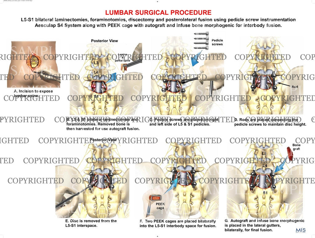 L5-S1 Lumbar surgical procedure