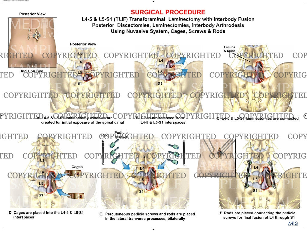 Transforaminal Laminectomy