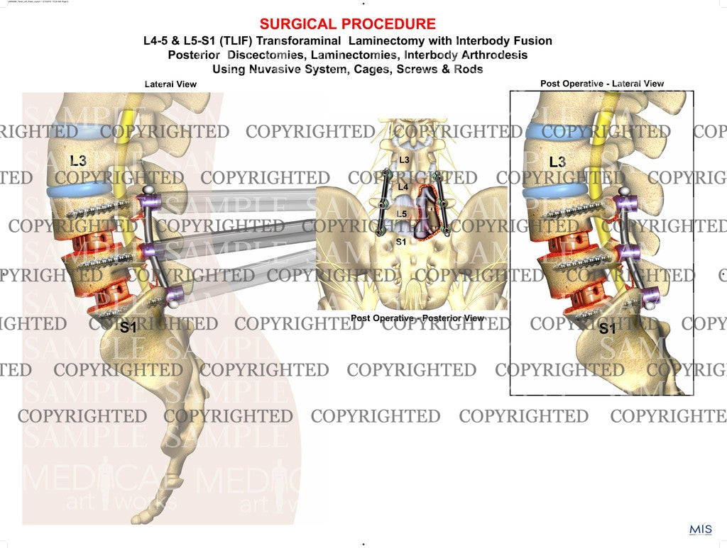 Transforaminal Laminectomy fusion