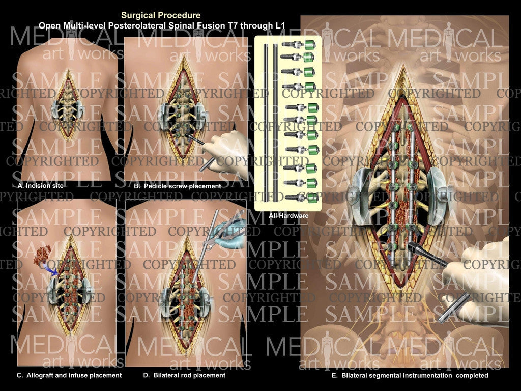 6 Level - Posterolateral spinal fusion