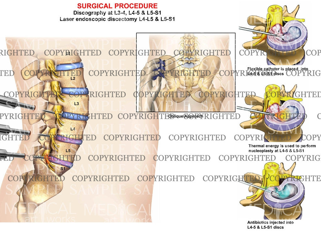 Lumbar laser endoscopic discectomy