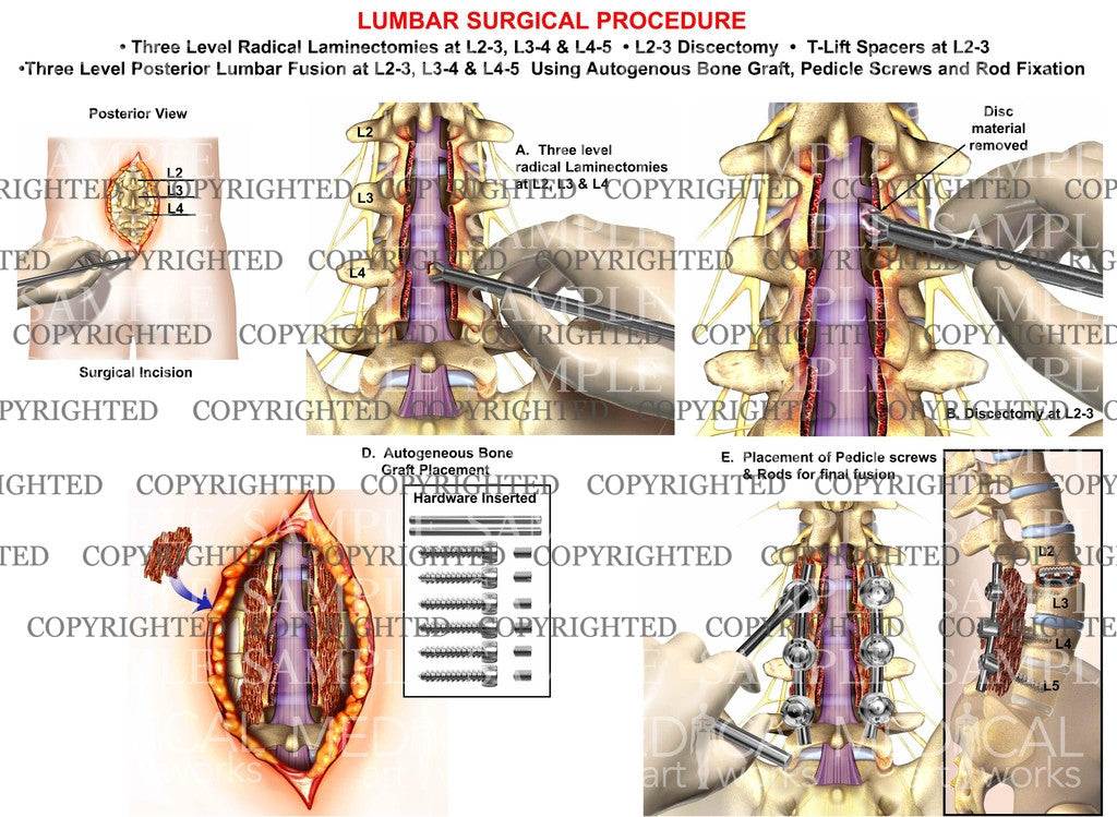 3 Level - L2-3, L3-4 and L4-5 Posterior lumbar laminectomies