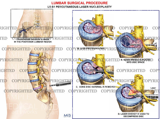 Lumbar Spine percutaneous discectomy