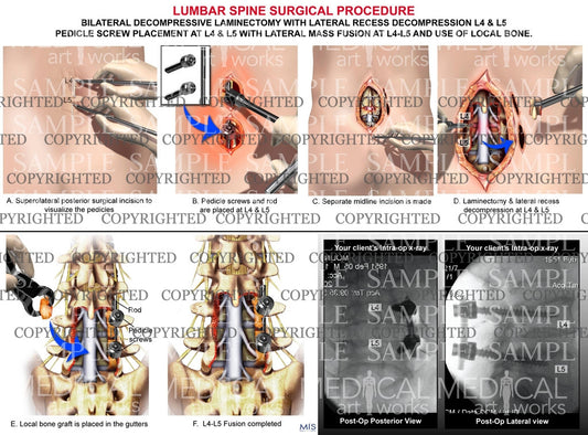Lumbar laminectomy with x-rays