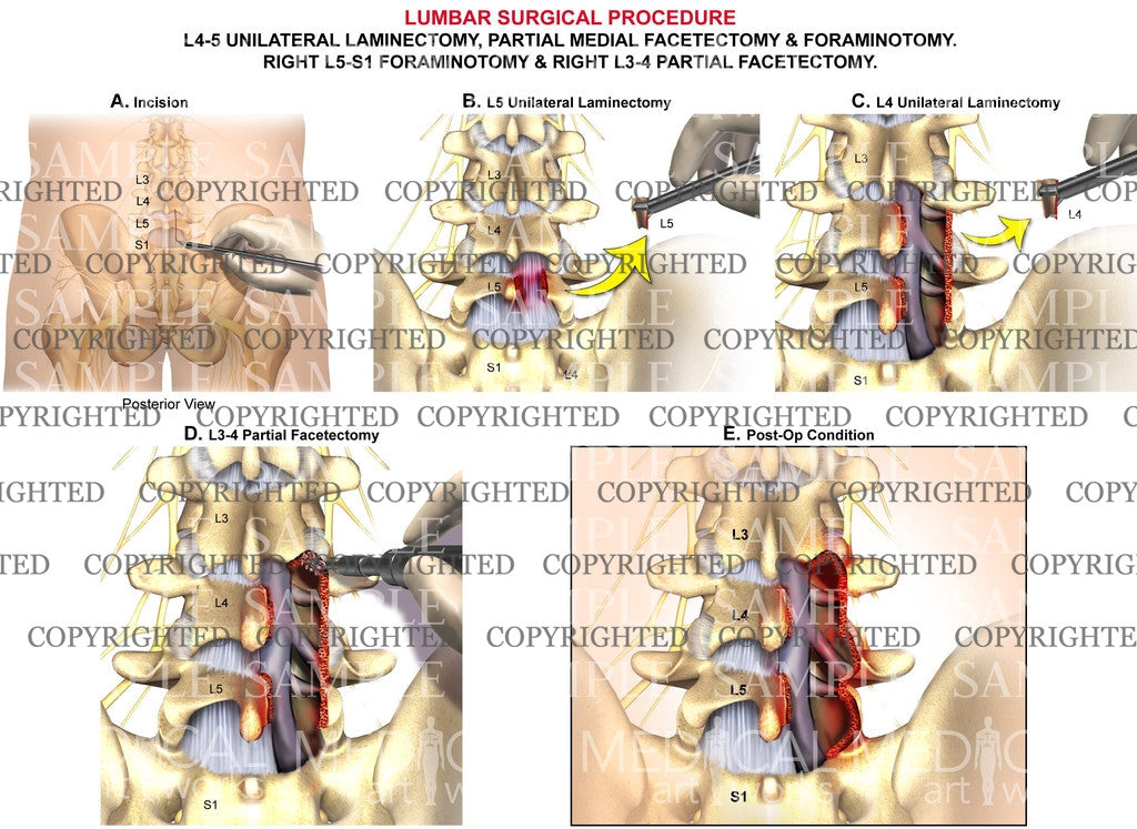 Lumbar unilateral laminectomy