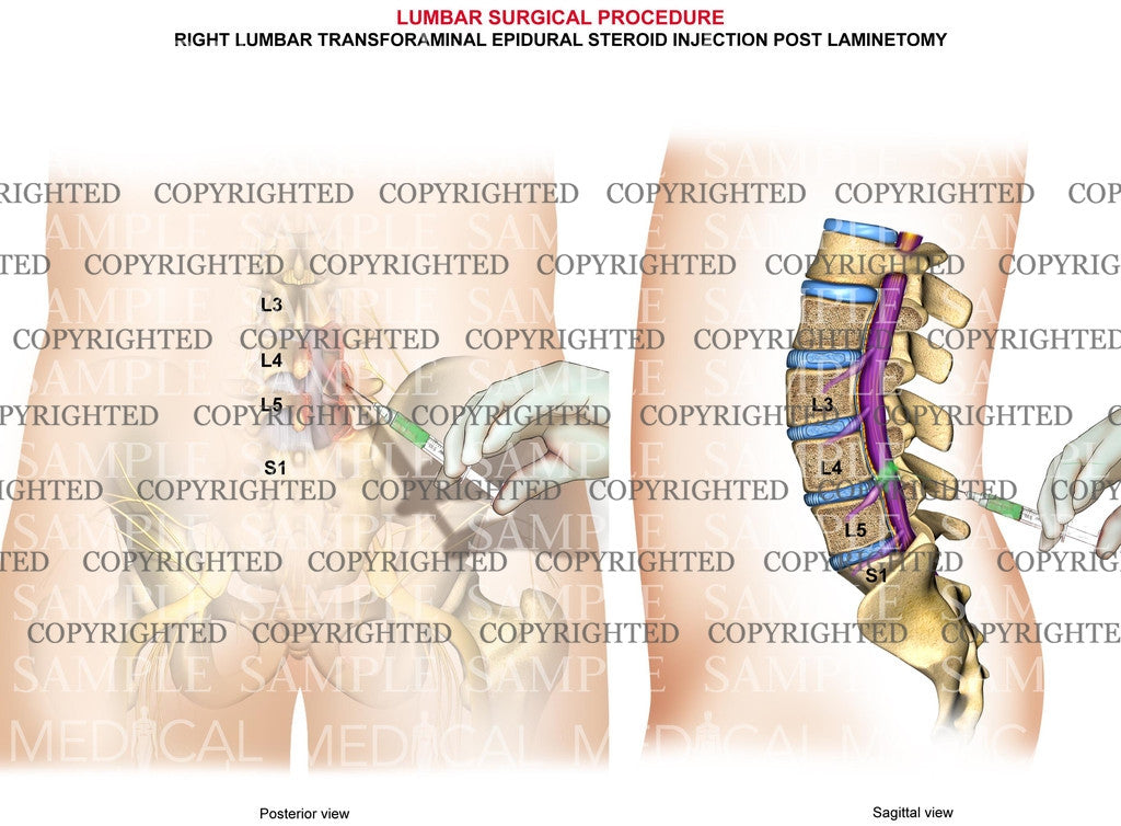 Lumbar epidural surgical procedure