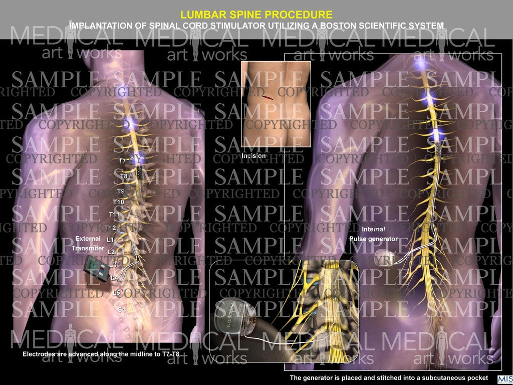 Spinal cord surgical procedure – Medical Art Works