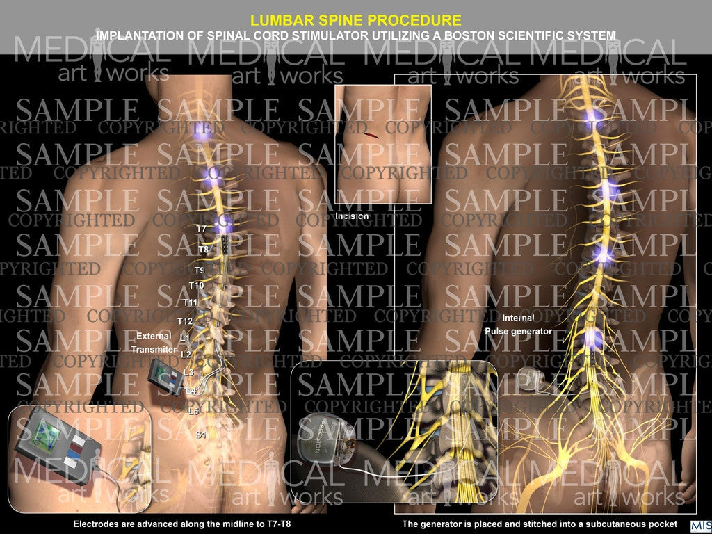 Lumbar spinal cord surgical procedure – Medical Art Works