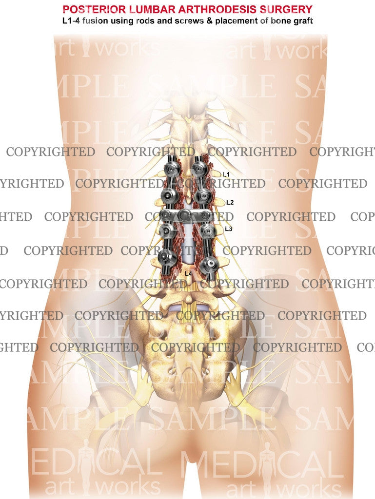 3 Level - Lumbar posterior arthrodesis surgery