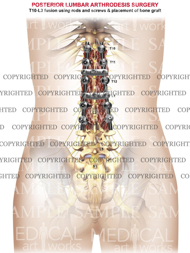 Lumbar and Thoracic 4 level posterior arthrodesis surgery