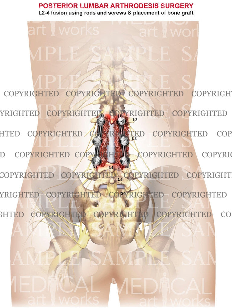 2 level - Lumbar posterior fusion surgery