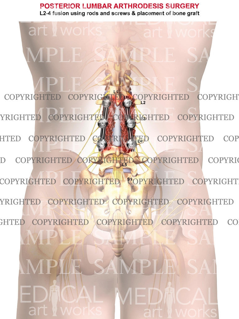 2 Level -  L2-3 & L3-4 Lumbar posterior interbody fusion surgery