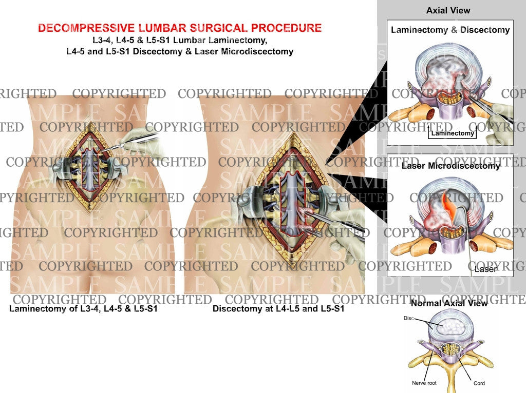 Lumbar Spine Decompression Surgical Procedure