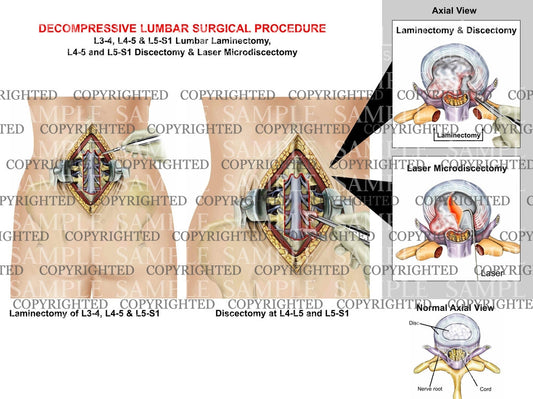 Decompressive lumbar Surgical Procedure