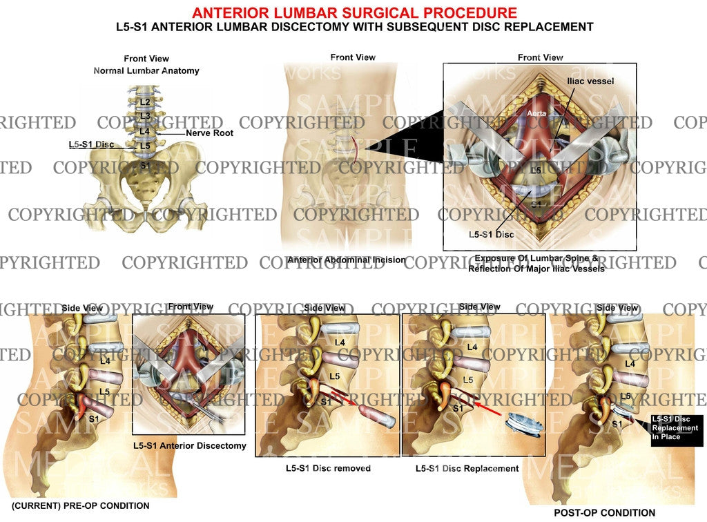 L5-S1 Anterior lumbar disc replacement