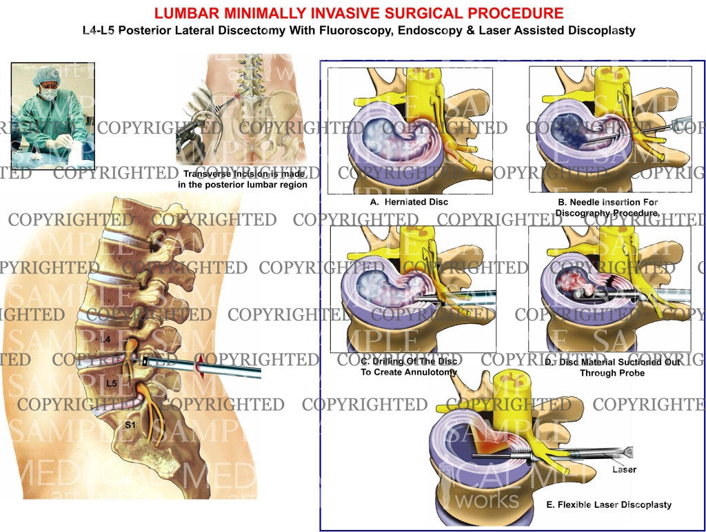 L4-L5 Lumbar minimally invasive surgery