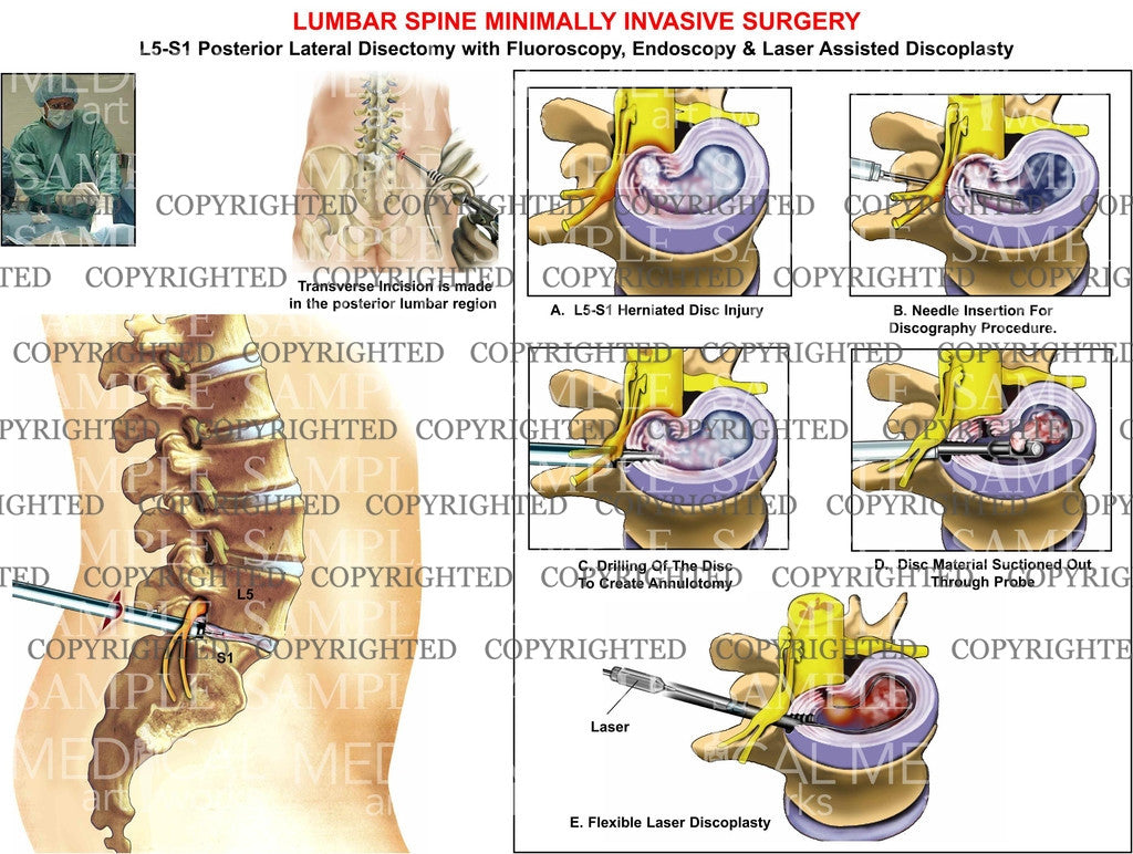 L5-S1 Lumbar posterior minimally invasive surgery