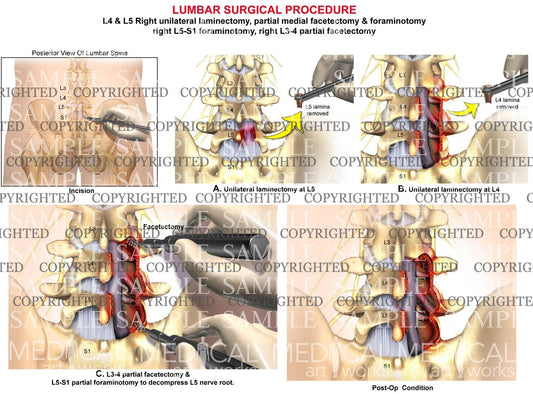 L4 & L5 Right unilateral laminectomy
