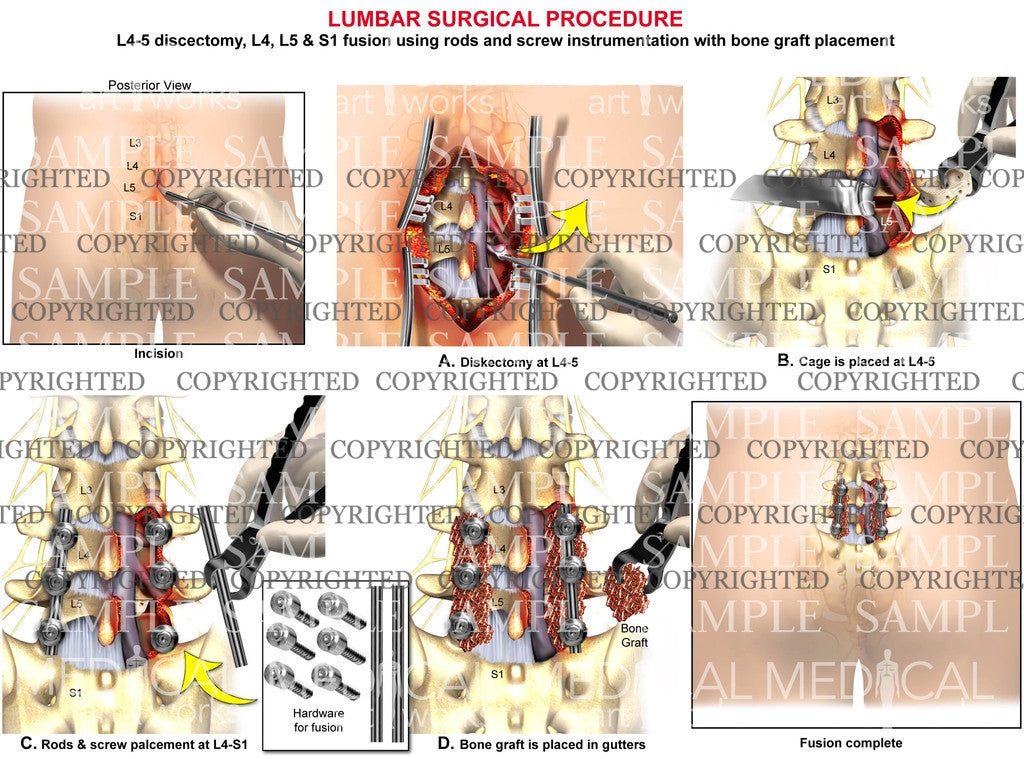 2 level - L4, L5, S1 Posterior lumbar interbody fusion surgery with rods and screws