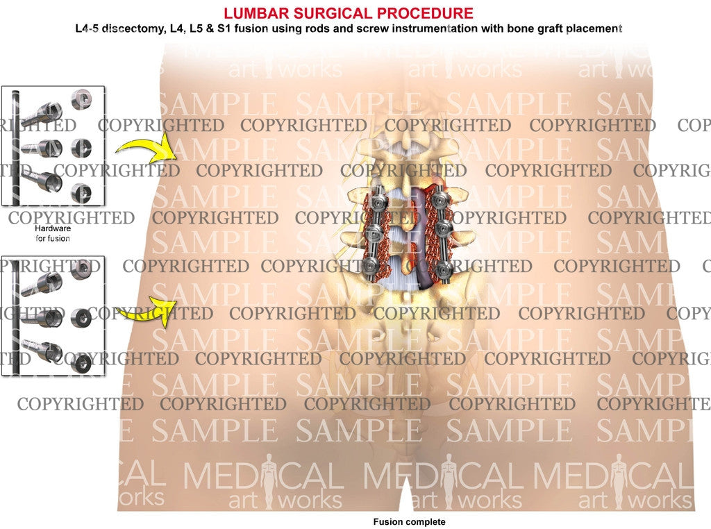 2 Level - L4, L5, S1 Post-op lumbar fusion