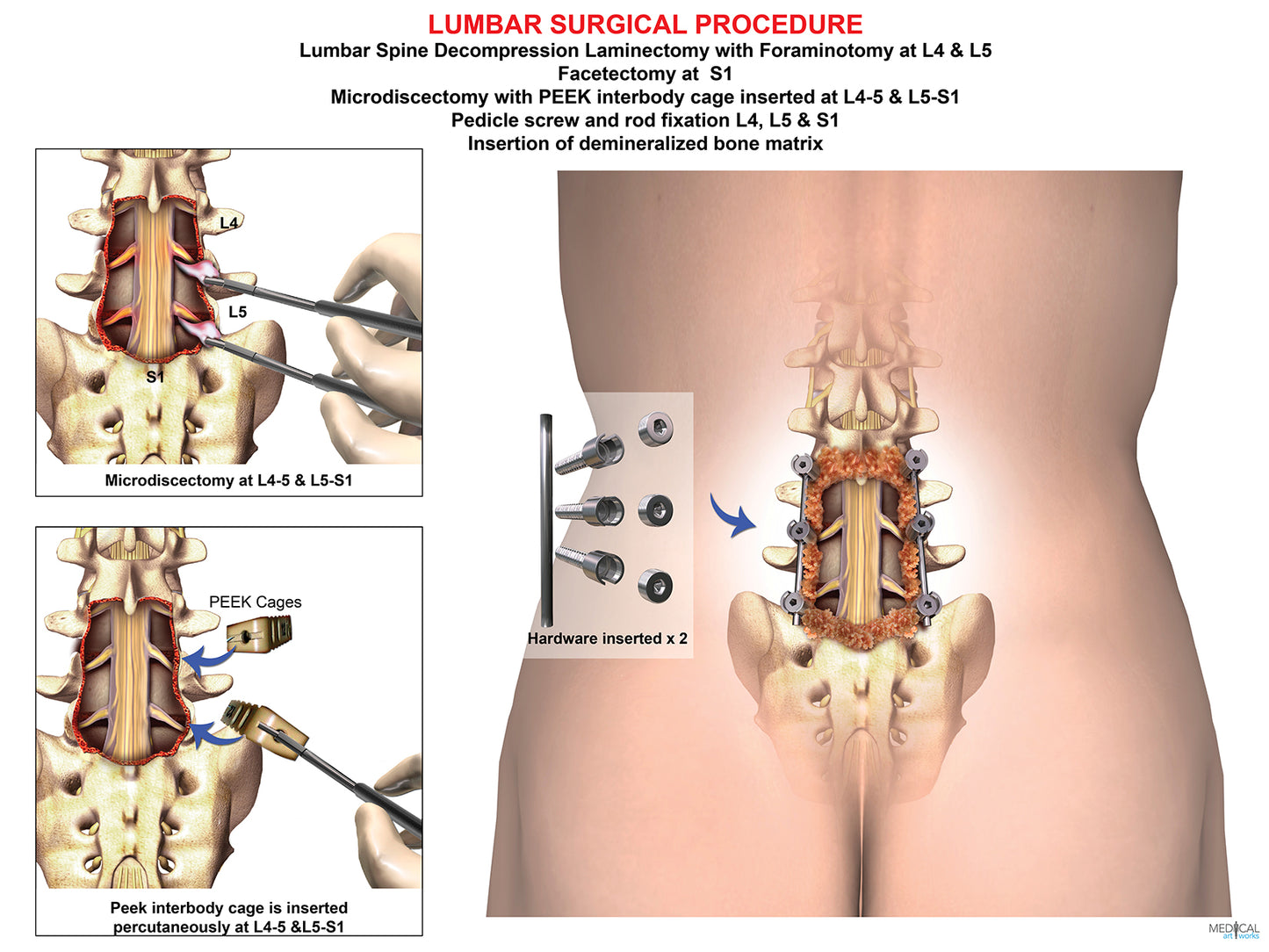 2 level - L4, L5, S1 Fusion, instrumentation, interbody graft