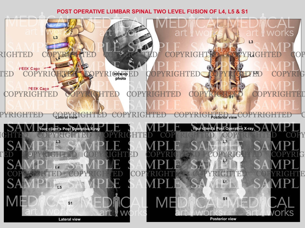 2 level - L4, L5, S1, Lumbar interbody fusion with post-op x-rays.