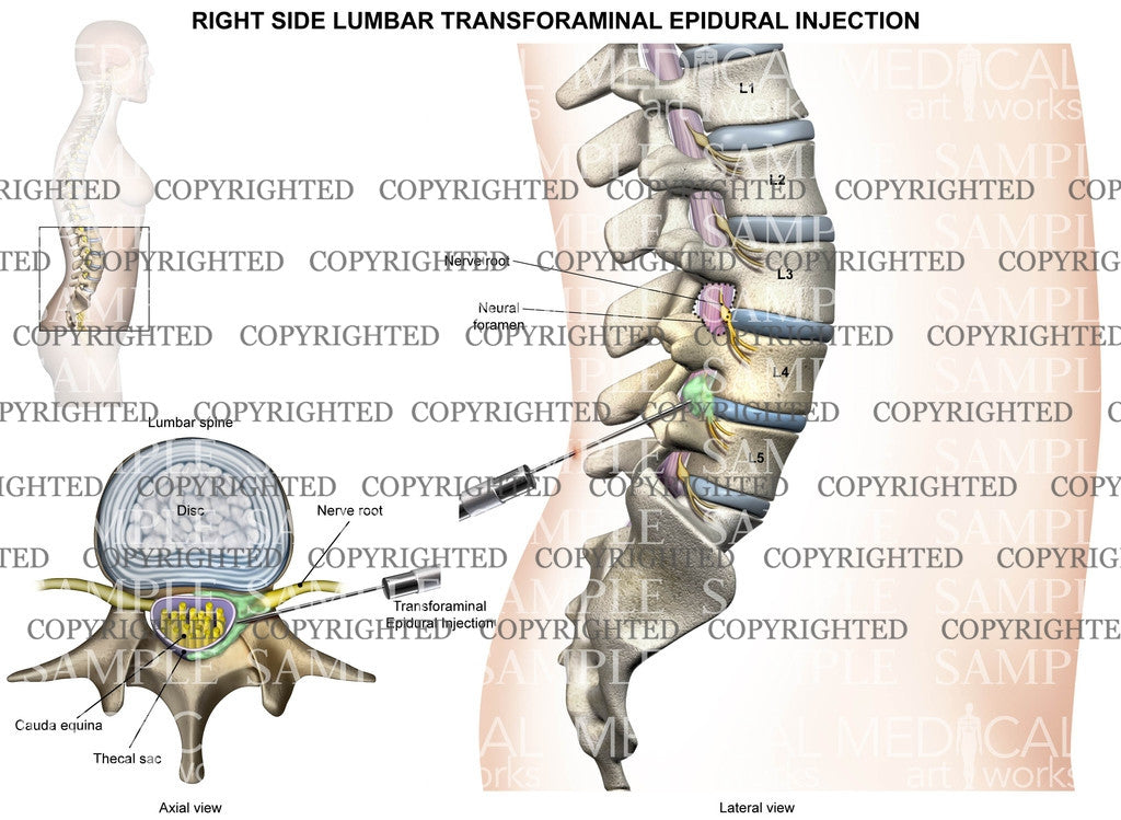 L4-5 Right side lumbar transforaminal epidural injection - Female