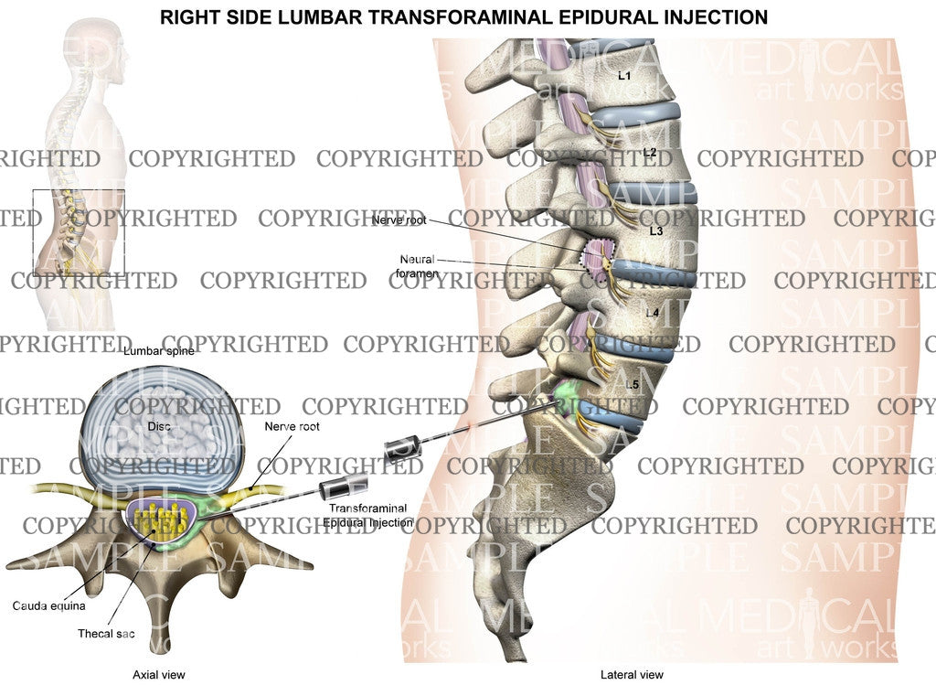 L5-S1 Right side lumbar transforaminal epidural injection - Male