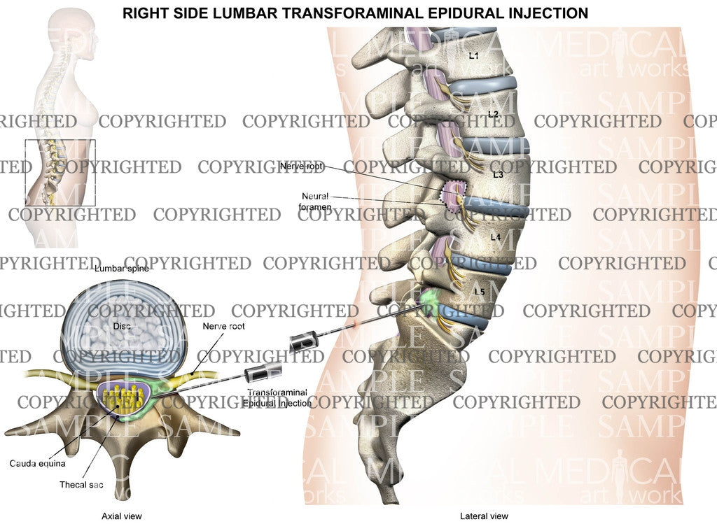 L5-S1 Right side female lumbar transforaminal epidural injection