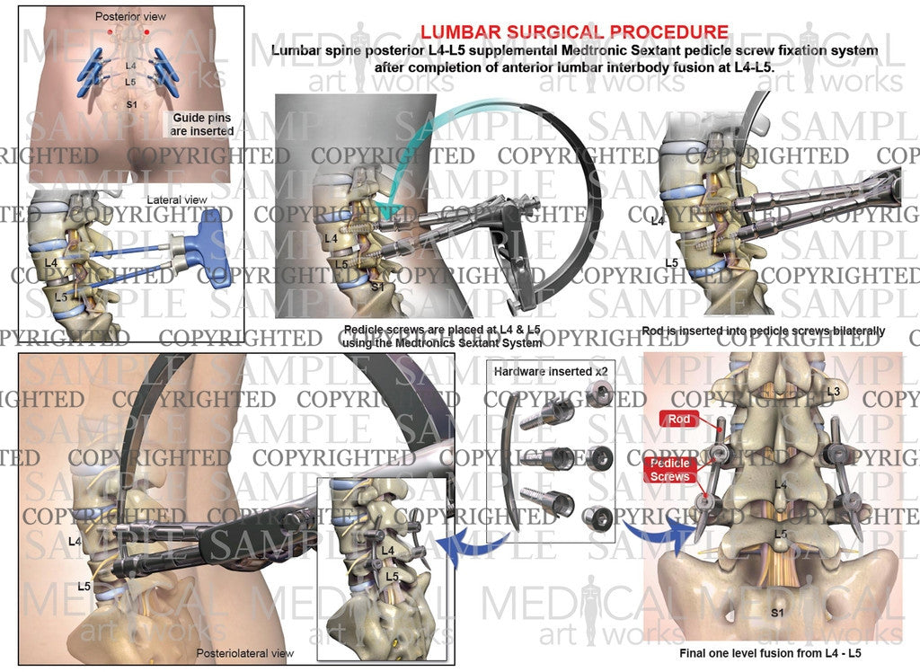L4-5 Posterior lumbar interbody fusion+medtronics sextant - male