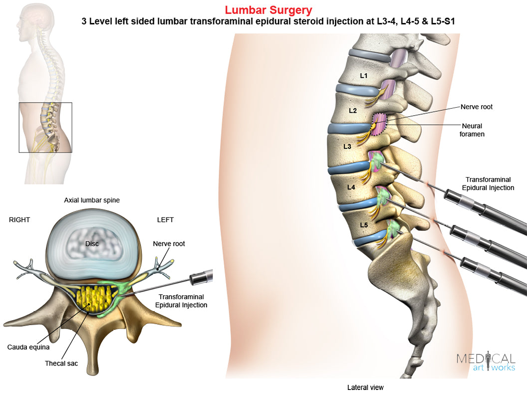 3 Level - Left-side lumbar Transforaminal Epidural Injection - Male