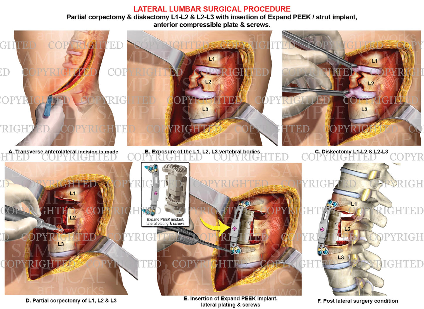 2 level - Lumbar lateral surgical procedure and fusion
