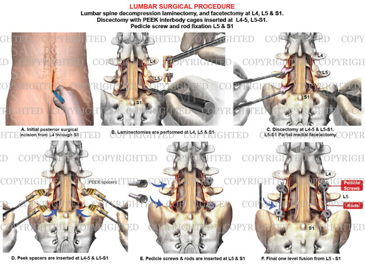 1 level - Lumbar spine fusion with instrumentation -  2 level L4-5 & L5-S1 discectomies