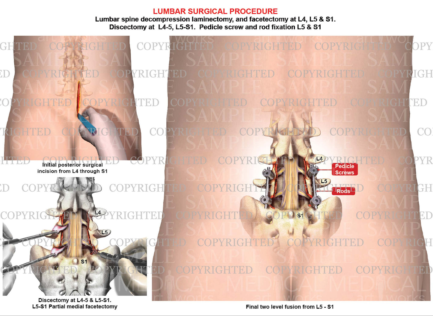 1 level Lumbar spine fusion