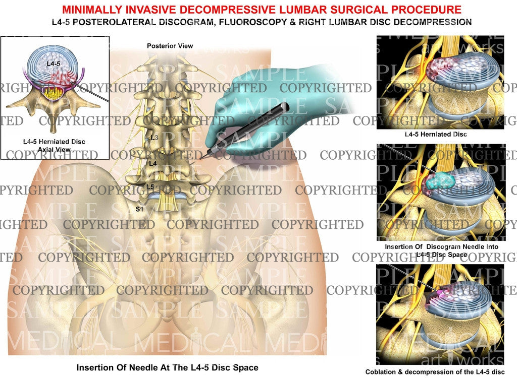 Minimally invasive decompressive lumbar Surgical Procedure