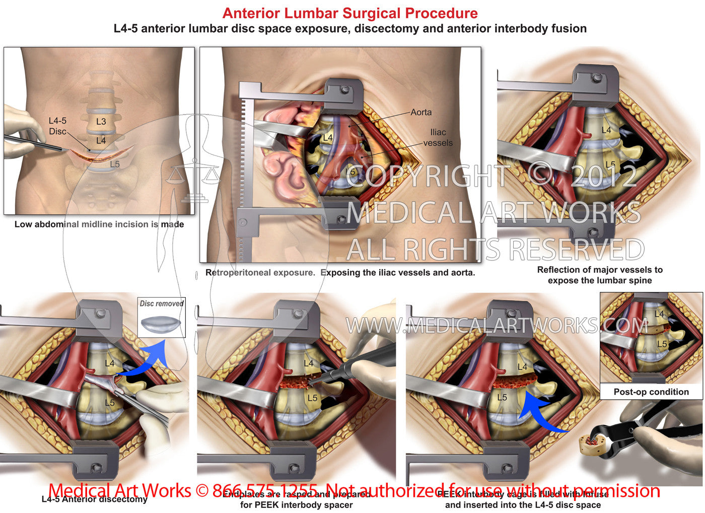 1 level - L4-5 Anterior lumbar interbody fusion and discectomy
