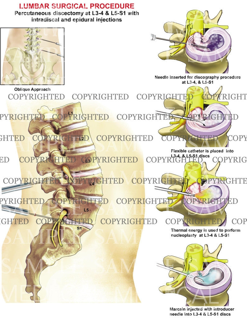 2 levels - Minimally invasive lumbar surgical procedure