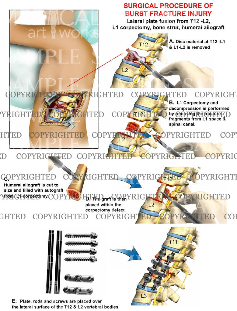 T12-L2 Vertebral arthrodesis