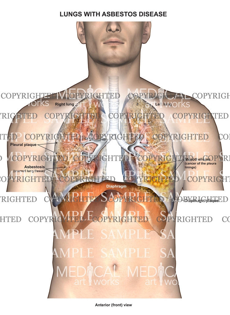 Lungs with asbestos disease