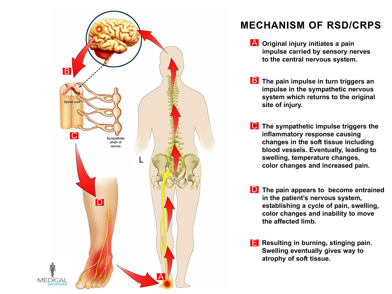 MECHANISM OF RSD: Reflex Sympathetic Dystrophy (Complex Regional Pain) 1