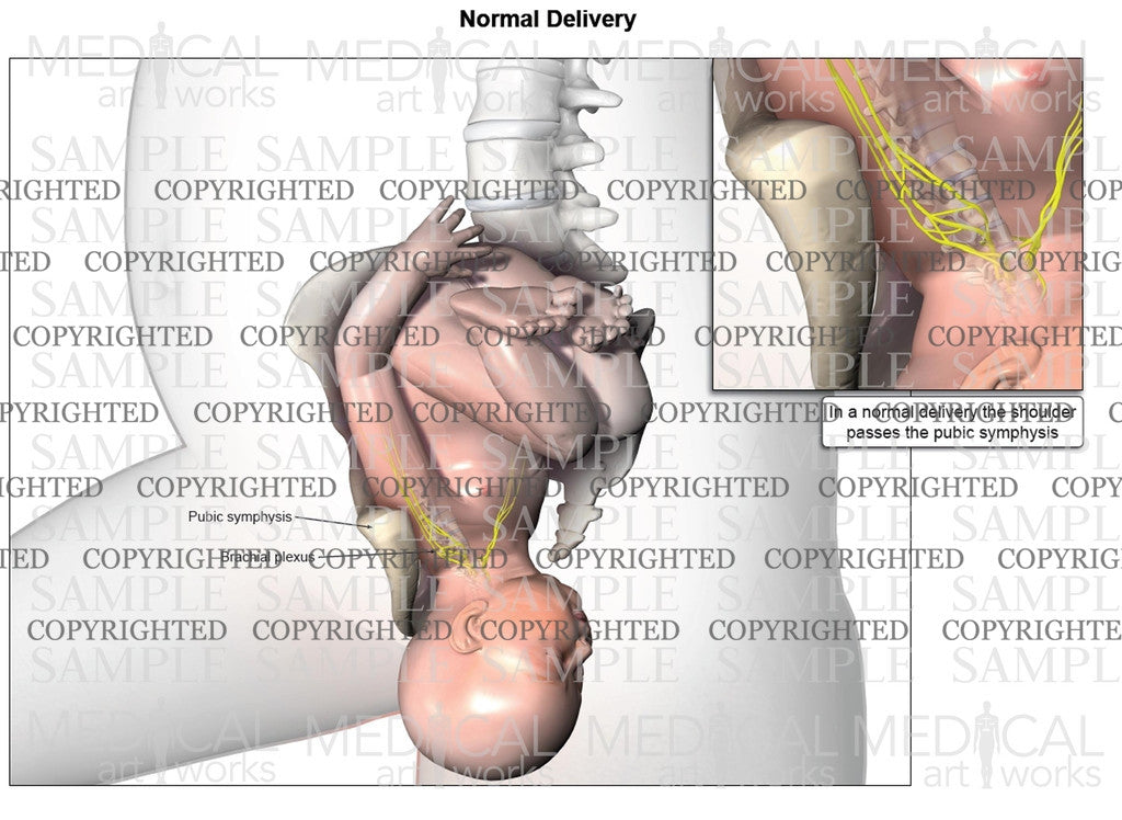 Left normal birth, vertical view