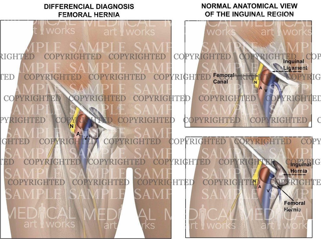 Differencial Diagnosis Femoral Hernia – Medical Art Works