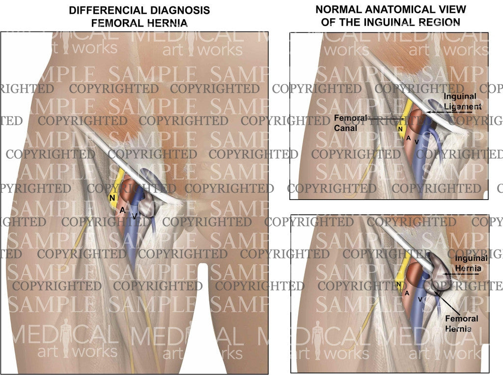 Differencial Diagnosis Femoral Hernia