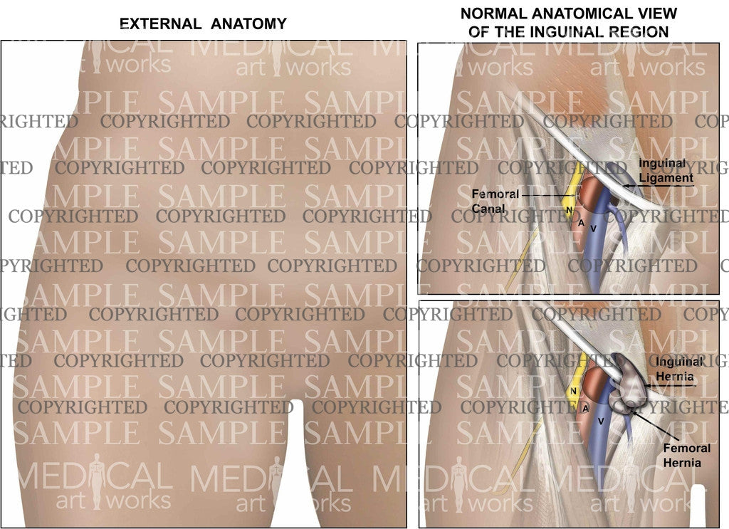 Differencial Diagnosis Femoral Hernia 1