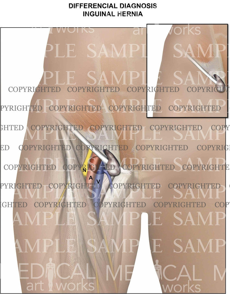Differencial Diagnosis inguinal Hernia