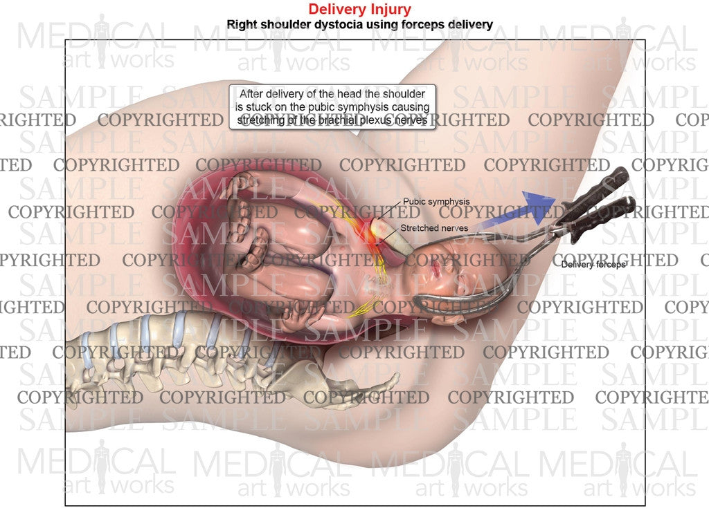 Right shoulder dystocia with forceps delivery