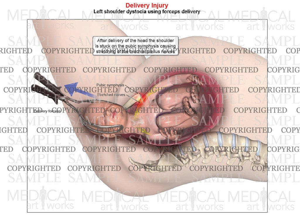 Left shoulder dystocia with forceps delivery